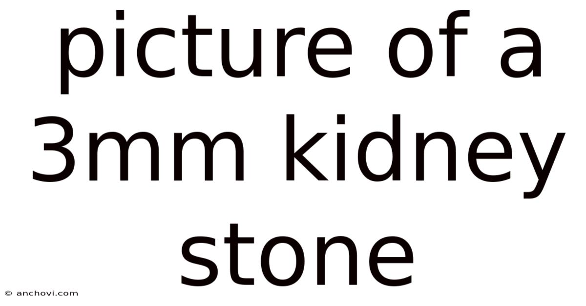 Picture Of A 3mm Kidney Stone