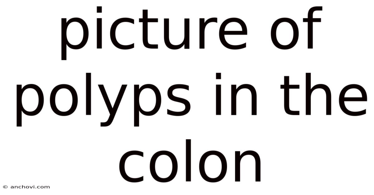 Picture Of Polyps In The Colon