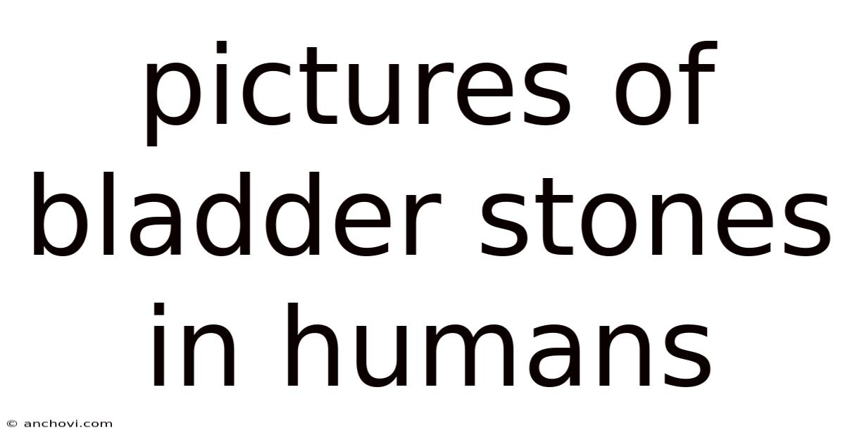 Pictures Of Bladder Stones In Humans